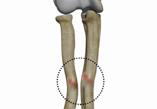 Malunion Surgery (Elbow)