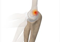 Posterior Impingement of the Elbow