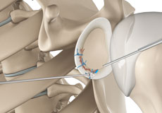 Arthroscopic Bankart Repair