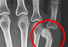 Boxer's Fracture