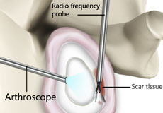 Capsular Release