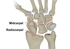 Carpal Instability