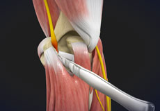 Cubital Tunnel Release (Medial Epicondylectomy)