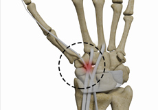 Distal Intersection Syndrome