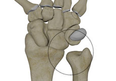 Distal Radioulnar Joint (DRUJ) Instability