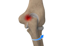 Elbow Impingement