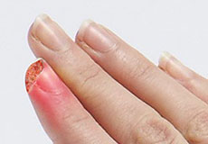 Fingertip Injuries