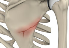 Fracture of the Shoulder Blade (Scapula)