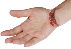 Nerve Lacerations