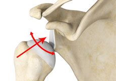 Multidirectional Instability of the Shoulder