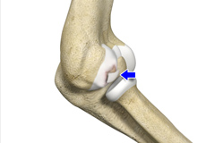 Osteochondritis Dissecans of the Capitellum