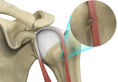 Proximal Biceps Tendinitis