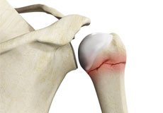 Proximal Humerus Fractures