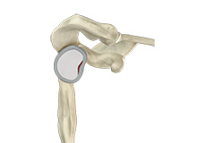 Revision Open Labral Repair (Revision Bankart)