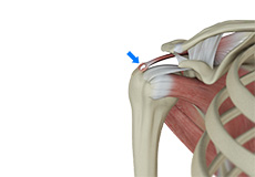 Rotator Cuff Calcification