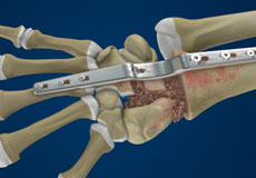 Total Wrist Arthrodesis