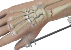 Wrist Fracture Fixation