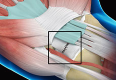 Wrist Ligament Reconstruction